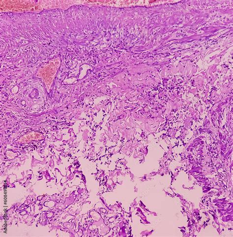 Soft Tissue Biopsy Glomus Tumor Or Paragangliomas Microscopically