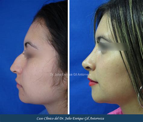 Rinoplastia Precios Cu Nto Cuesta Cirugia De Nariz Cu Nto Sale