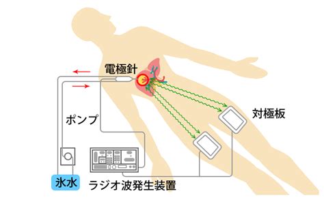 ラジオ波焼灼療法（rfa）｜教えてお医者さん