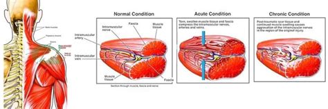 Fascial Manipulation Treatment Part 2 Lamberti Physiotherapy