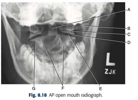 Fig 8 18 AP Open Mouth Radiograph Diagram Quizlet