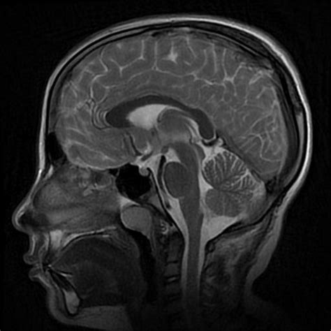 Arachnoid Cyst Middle Cranial Fossa Image