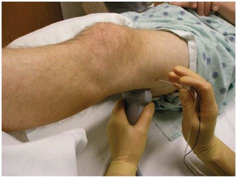 Popliteal Nerve Block Ultrasound