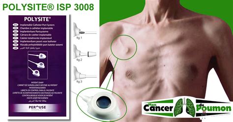 Chambre Implantable Port Cath Ou Pac Laisser En Place Ou Retirer