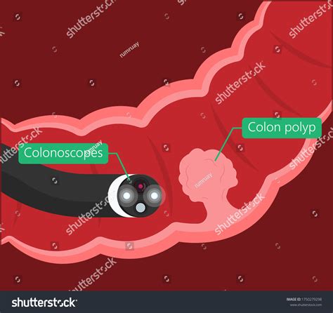 756 Colonoscopy Polyp Images, Stock Photos & Vectors | Shutterstock