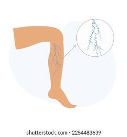 Varicose Veins Legs Vascular Spider Veins Stock Vector (Royalty Free ...