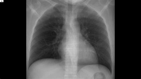 COVID-19 pneumonia – Chest X-ray or CT? - Siemens Healthineers