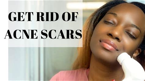 How To Get Rid Of Acne Scars Dark Marks Youtube