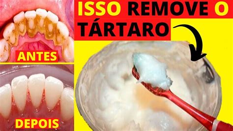 Como Remover O T Rtaro Dos Dentes Em Casa E Ter Dentes Brancos Youtube