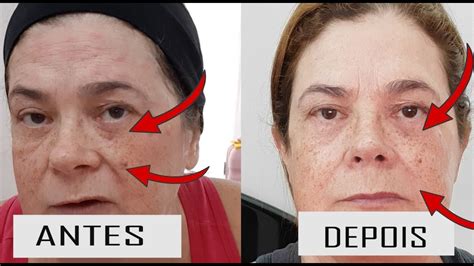 Antes E Depois Como EstÁ Minha Pele ApÓs Um Dia Do Skinbooster Sera