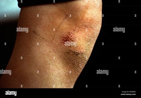 Grazed Knee Hi Res Stock Photography And Images Alamy