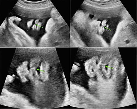 Prenatal Ultrasonographic Diagnosis Of Cleft Lip With Or Without Cleft