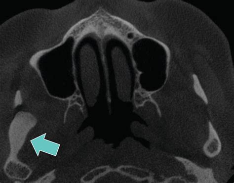 Of Ultrasonography In Maxillofacial Intraoral Benign And Malignant