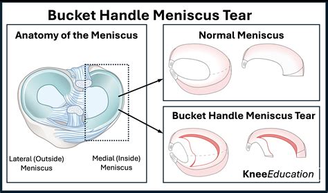 Bucket Handle Meniscus Tear - Knee Education