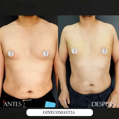 Gynecomastia Dr Carlos Recio Cirujano Pl Stico En Cali