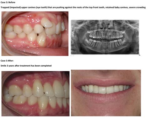 Teeth Before And After Braces Crowding