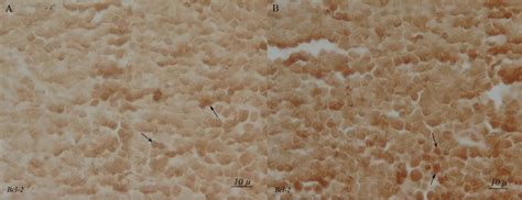 Light Photomicrographs Show Immunohistochemical Expression Of Bcl 2 In