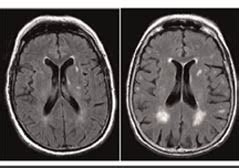 Lesiones De La Sustancia Blanca En Resonancia Cerebral Una Gu A Completa