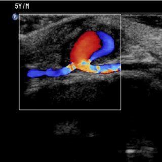 Lower Extremity Doppler Ultrasonography Of A Cm Partially Thrombosed