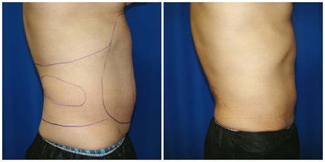 Patient 261 Female Liposuction Before And After Photos Katy Plastic Surgery Gallery Houston