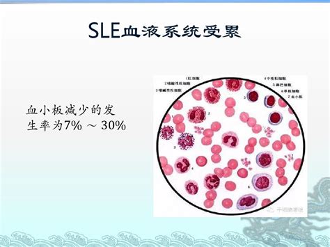 系统性红斑狼疮相关血小板减少ppt医学课件 word文档在线阅读与下载 无忧文档