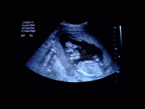 Fetus ultrasound stock photo. Image of medicine, ultrasound - 5993284