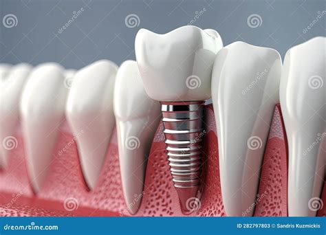 Dental Implant Illustration Generative Ai Stock Illustration