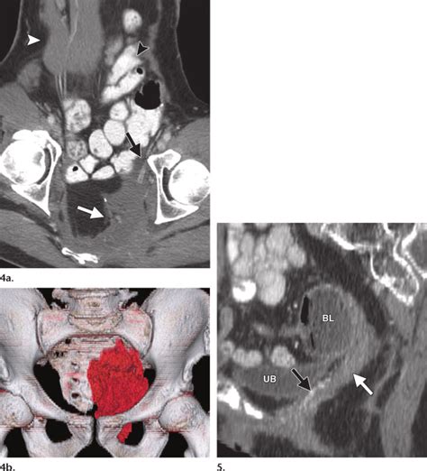 5 4a Curved Reformatted Contrast Material Enhanced Ct Image Download Scientific Diagram