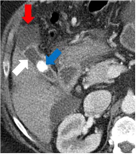 Diagnosing Gallbladder Perforation With Contrast Enhanced Ultrasound A