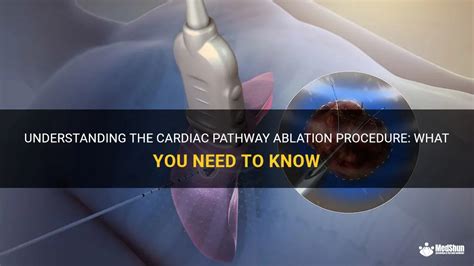 Understanding The Cardiac Pathway Ablation Procedure What You Need To