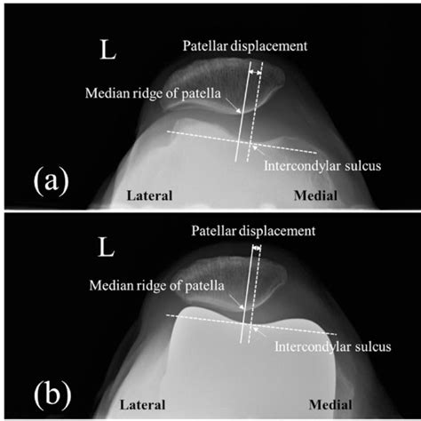 Measurements Of Patellar Tilt Angle And Patellar Displacement A Download Scientific Diagram