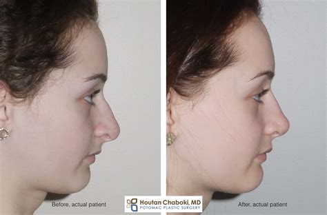 Augmenting The Root Of The Nose To Improve Profile In Rhinoplasty