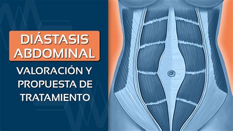 Di Stasis Abdominal Valoraci N Y Propuesta De Tratamiento Youtube