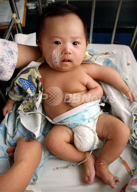 腕が3本ある赤ちゃん、除去手術を計画 中国 写真1枚 国際ニュース：afpbb News