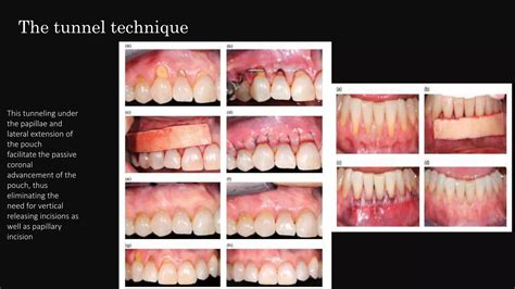 Minimally Invasive Periodontal Surgery Ppt