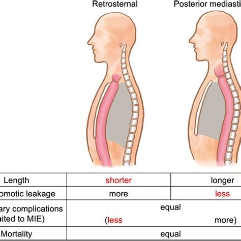 Illustration Comparing The Ivor Lewis And Mckeown Procedures