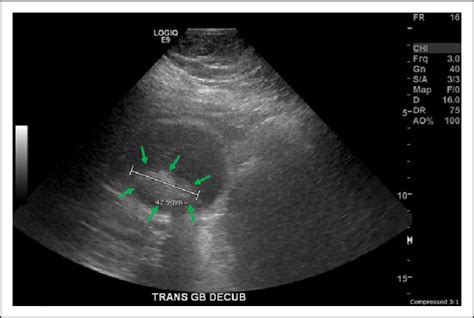 Ultrasound Image Shows Shadowing Gallstones The Largest Gallstone