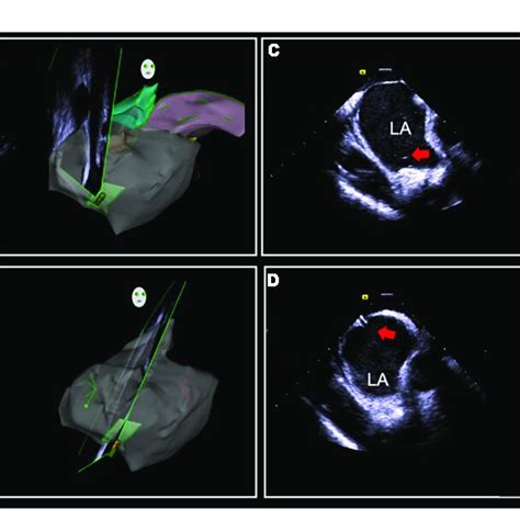 Intracardiac ICE Guided Zero X Ray Transseptal Puncture A