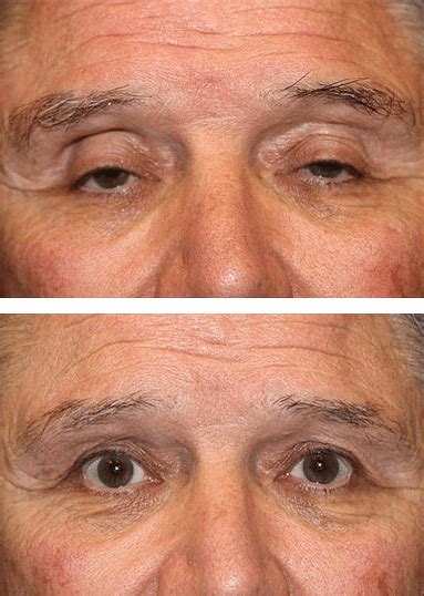 Ptosis Repair Dallas Ophthalmology Surgeons Texas Ophthalmic