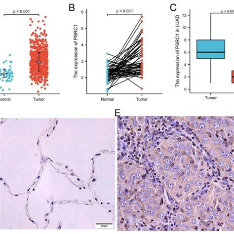 PSRC1 Expression In LUAD A PSRC1 Expression Levels In LUAD And Normal