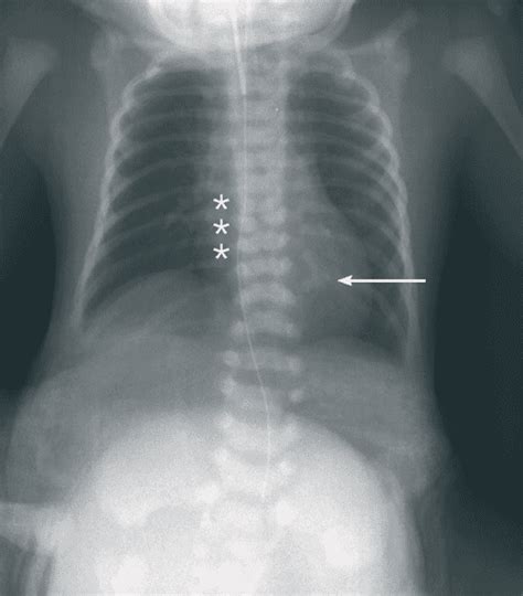 OEIS Complex : developmental insights into a severe congenital ...