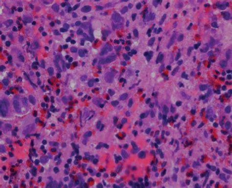 Eosinophilic Granuloma Pathology Orthobullets