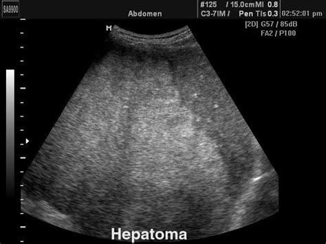 Ultrasound Images • Liver Hepatoma B Mode Echogramm №154