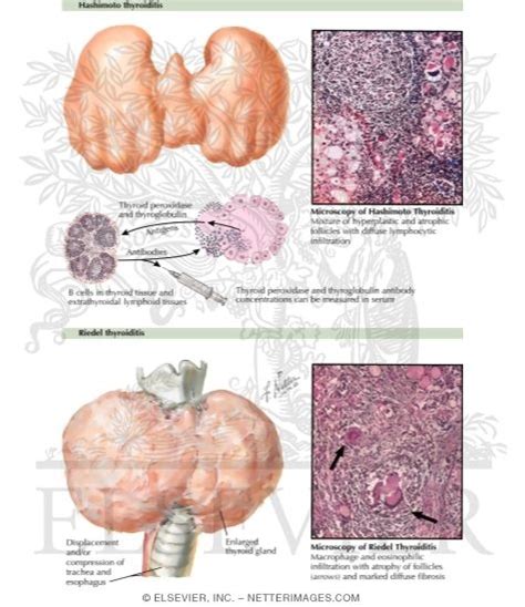 Chronic Chronic Lymphocytic Thyroiditis