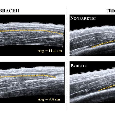 Extended Field Of View Ultrasound Images Of The Long Head Of Biceps