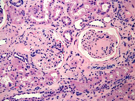 Pathology Outlines - Nonneoplastic kidney