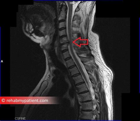 Cervical Radiculopathy Pinched Nerve Rehab My Patient Nbkomputer