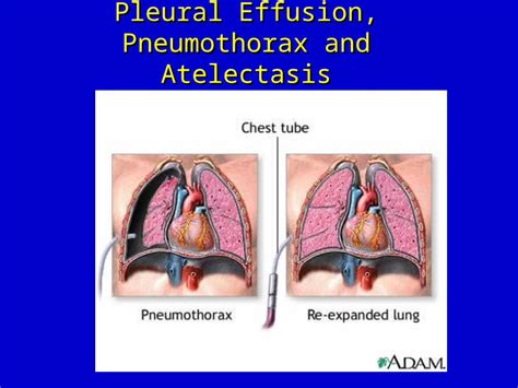 Ppt Pleural Effusion Pneumothorax And Atelectasis Mosby Items And