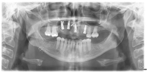 Outcomes Of Osseointegrated Implants In Patients With Benign And