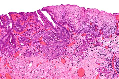 Difference Between Esophageal And Gastric Epithelium Compare The